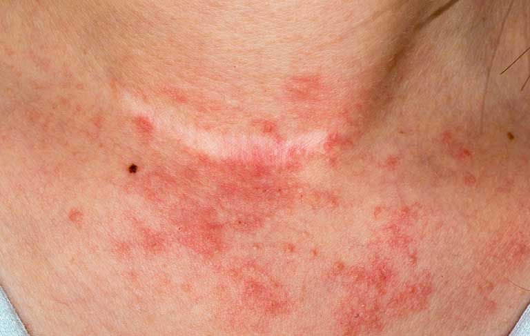 About Atopic dermatitis 5.jpg